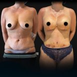 Résultats avant/après liposuccion chez Soraca Med – amélioration visible de la silhouette
