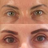 Before and after upper eyelid surgery results at Soraca Med, rejuvenated eye appearance