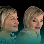 Before and after upper eyelid surgery results at Soraca Med, visible eyelid rejuvenation