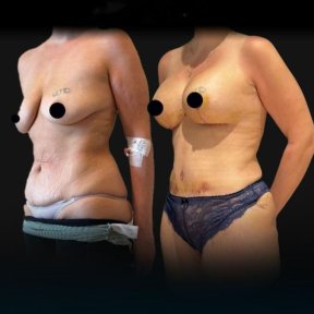 before-after photo tummy-tuck-and-liposuction
