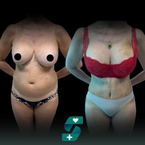 before-after photo tummy-tuck-and-liposuction