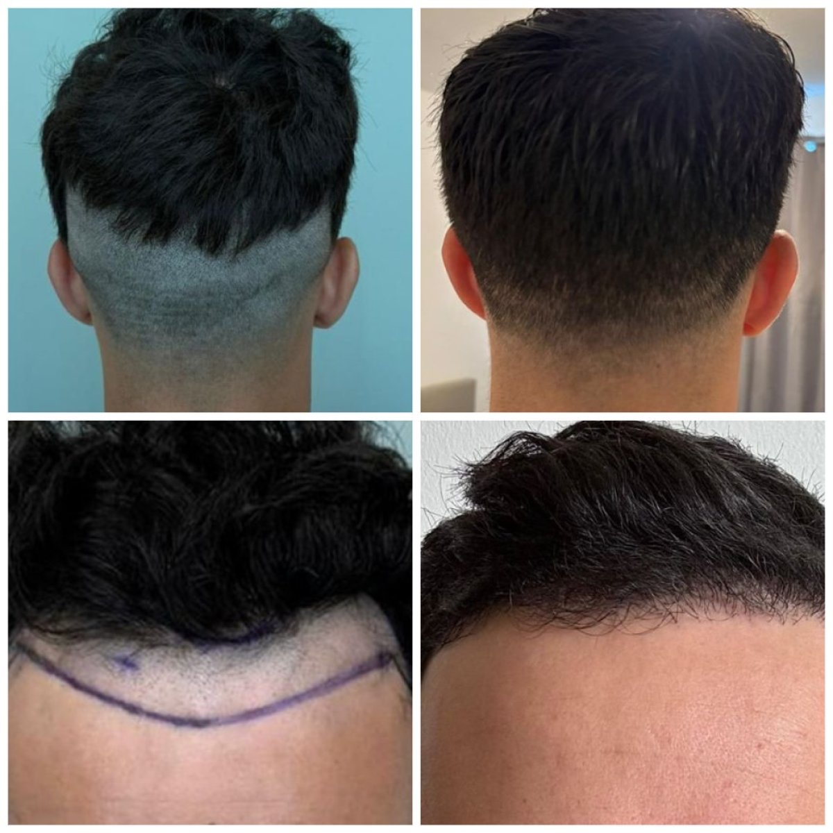 نتائج زراعة الشعر قبل وبعد في Soraca Med، خط شعر ومنطقة مانحة محسنة