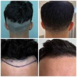نتائج زراعة الشعر قبل وبعد في Soraca Med، خط شعر ومنطقة مانحة محسنة