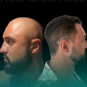 before-after photo hair-transplant