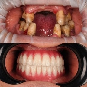 before-after photo dental-prosthetics-installation