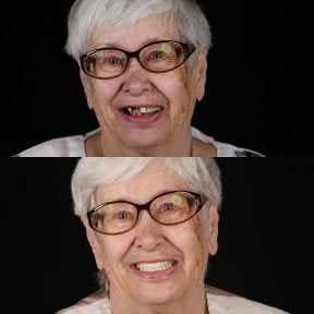 before-after photo dental-prosthetics-installation