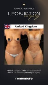before-after photo 360-liposuction