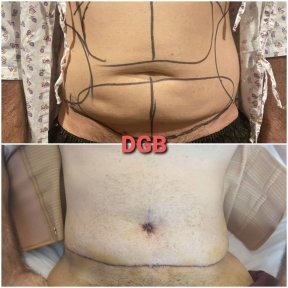 Before and after mommy makeover at DGB Clinic, visible abdominal contour improvement result