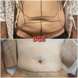 Before and after mommy makeover at DGB Clinic, visible abdominal contour improvement result