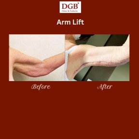 Before and after arm lift results at DGB Clinic, improved arm contour after brachioplasty