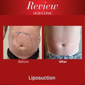 Before and after liposuction results at DGB Clinic – visible abdominal contour improvement