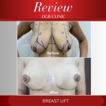 Before and after breast lift results at DGB Clinic, improved breast shape and contour