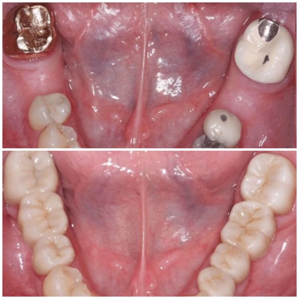 Resultados antes y después de puente dental de zirconia en SoftDentalCare Clinic, restauración dental