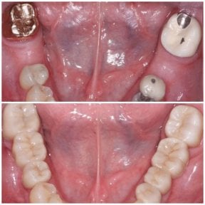 before-after photo zirconia-dental-bridge