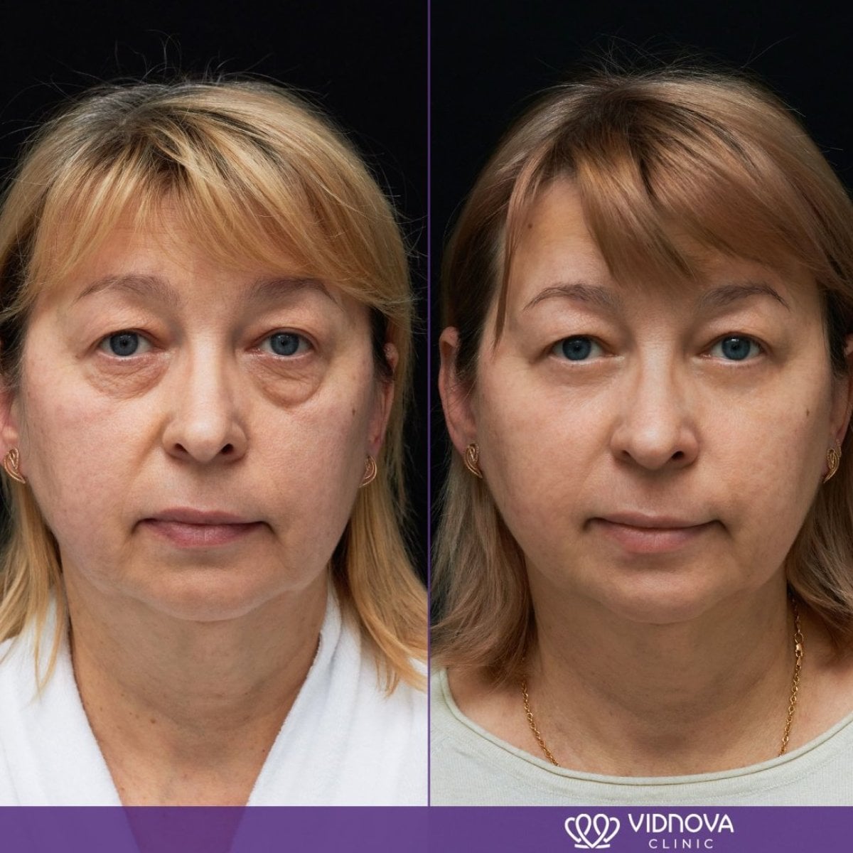 Resultados de blefaroplastia antes y después en Vidnova Clinic – corrección de párpados