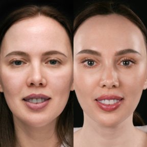 Before and after brow lift results at Vidnova Clinic – visible eyebrow and forehead rejuvenation