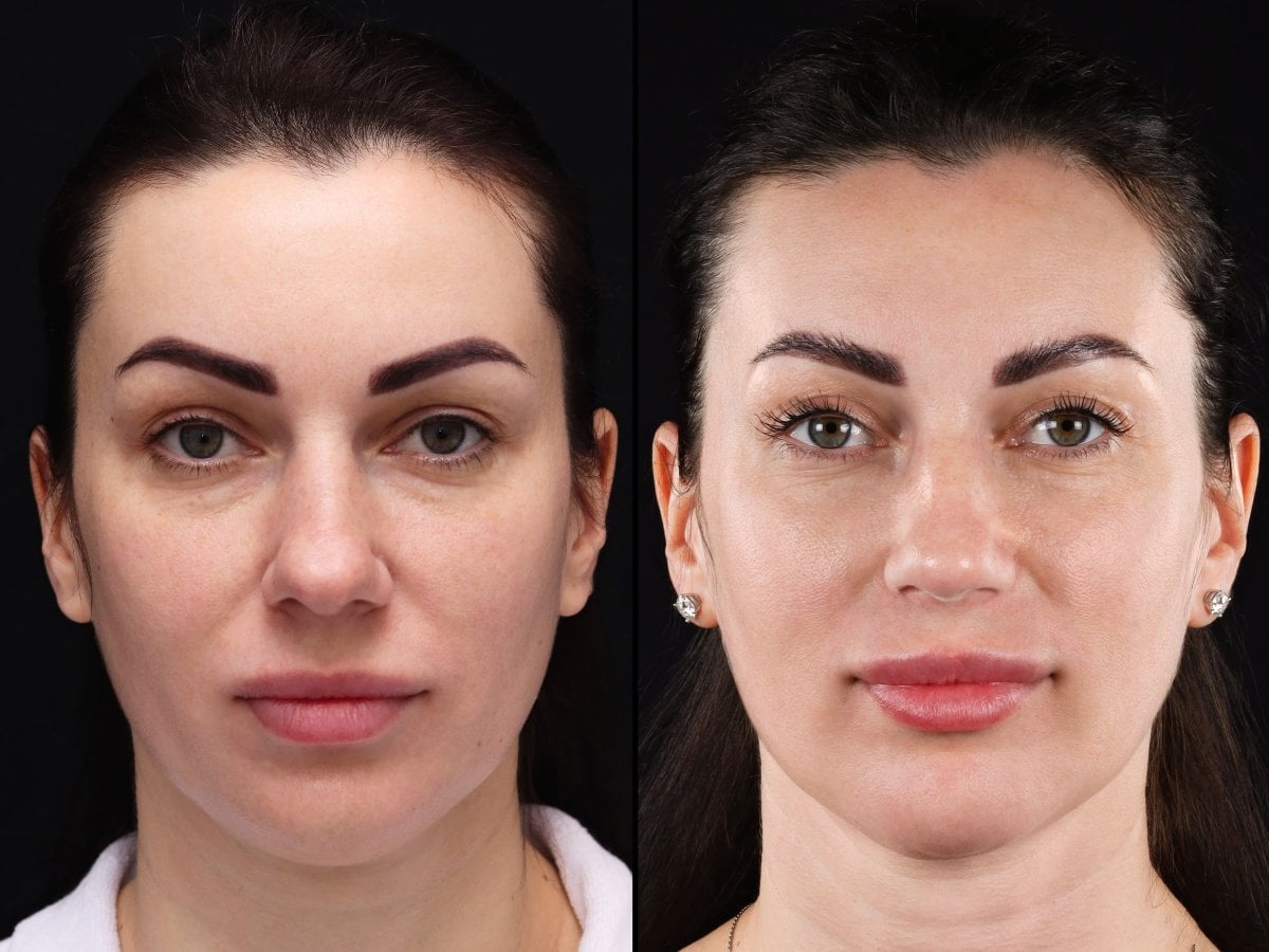 Resultados de lifting de cejas antes y después en Vidnova Clinic, rejuvenecimiento visible