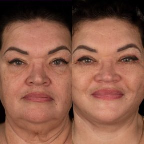 before-after photo brow-lift