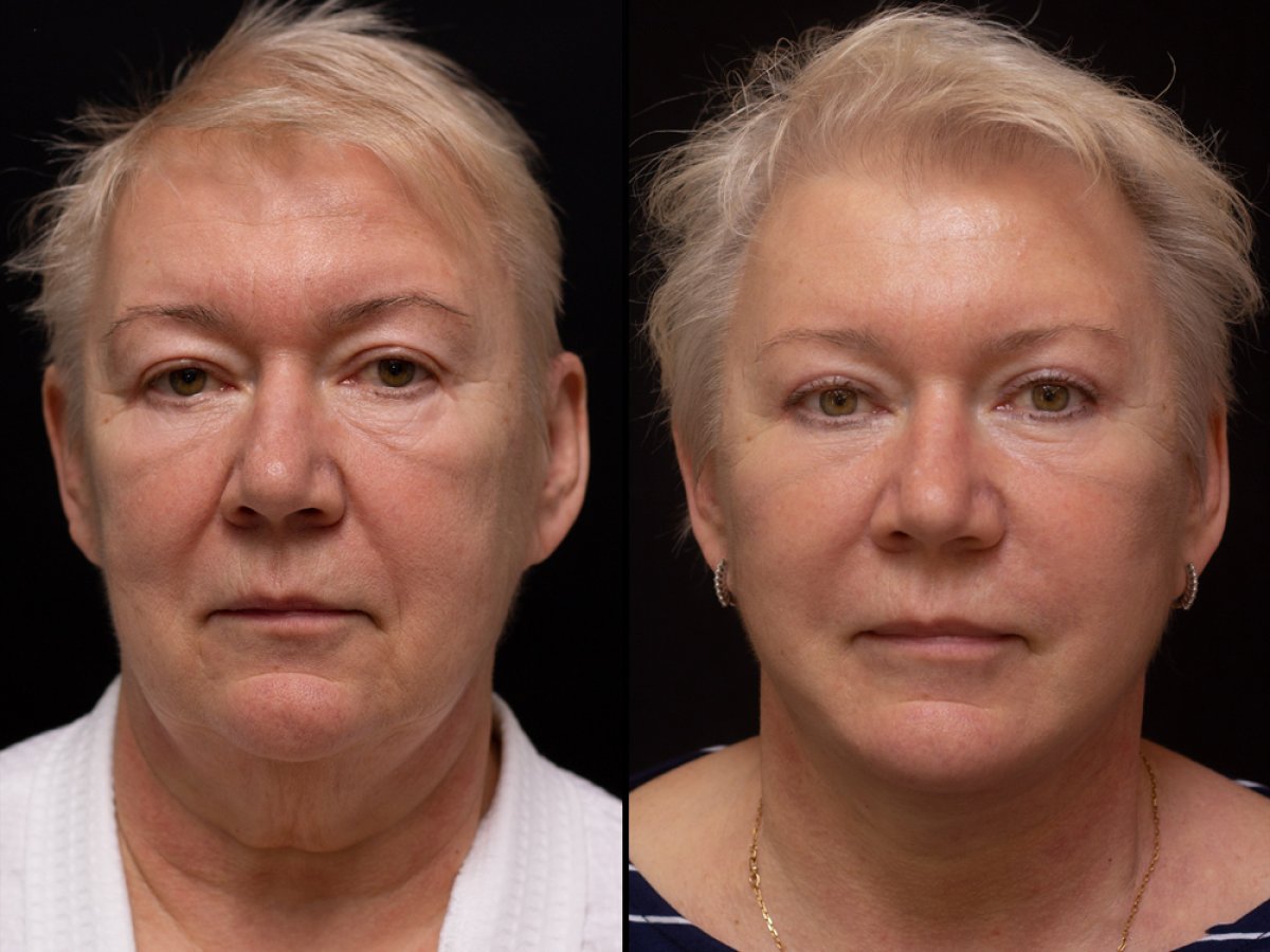 Resultados de lifting de cejas antes y después en Vidnova Clinic – frente y ojos rejuvenecidos