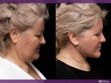 before-after photo tightening-of-facial-skin-facelift