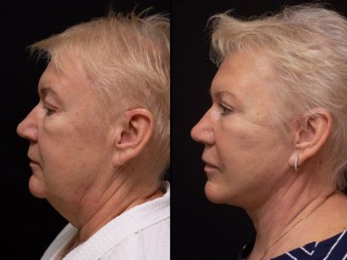 before-after photo tightening-of-facial-skin-facelift
