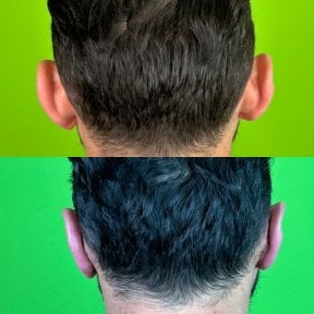 before-after photo otoplasty-ear-surgery