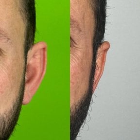 before-after photo otoplasty-ear-surgery