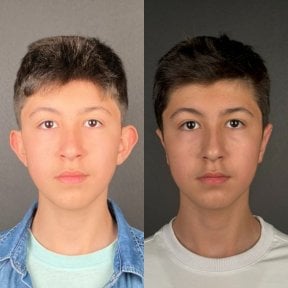 before-after photo otoplasty-ear-surgery