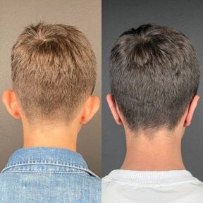 before-after photo otoplasty-ear-surgery