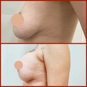 before-after photo breast-augmentation