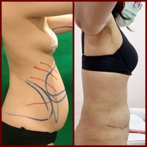 Before and after mommy makeover at DGB Clinic – visible abdominal contour improvement result
