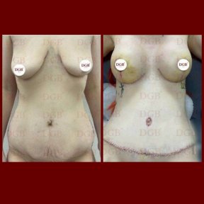 Before and after mommy makeover at DGB Clinic – visible body contouring and breast lift result