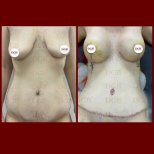 Before and after mommy makeover at DGB Clinic – visible body contouring and breast lift result