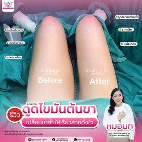 Before and after thigh liposuction results at Somchai Clinic, slimmer legs after procedure