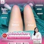 Before and after thigh liposuction results at Somchai Clinic, slimmer legs after procedure