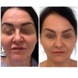 Результати до і після Deep Plane Facelift у клініці Radzikowska, омолодження обличчя