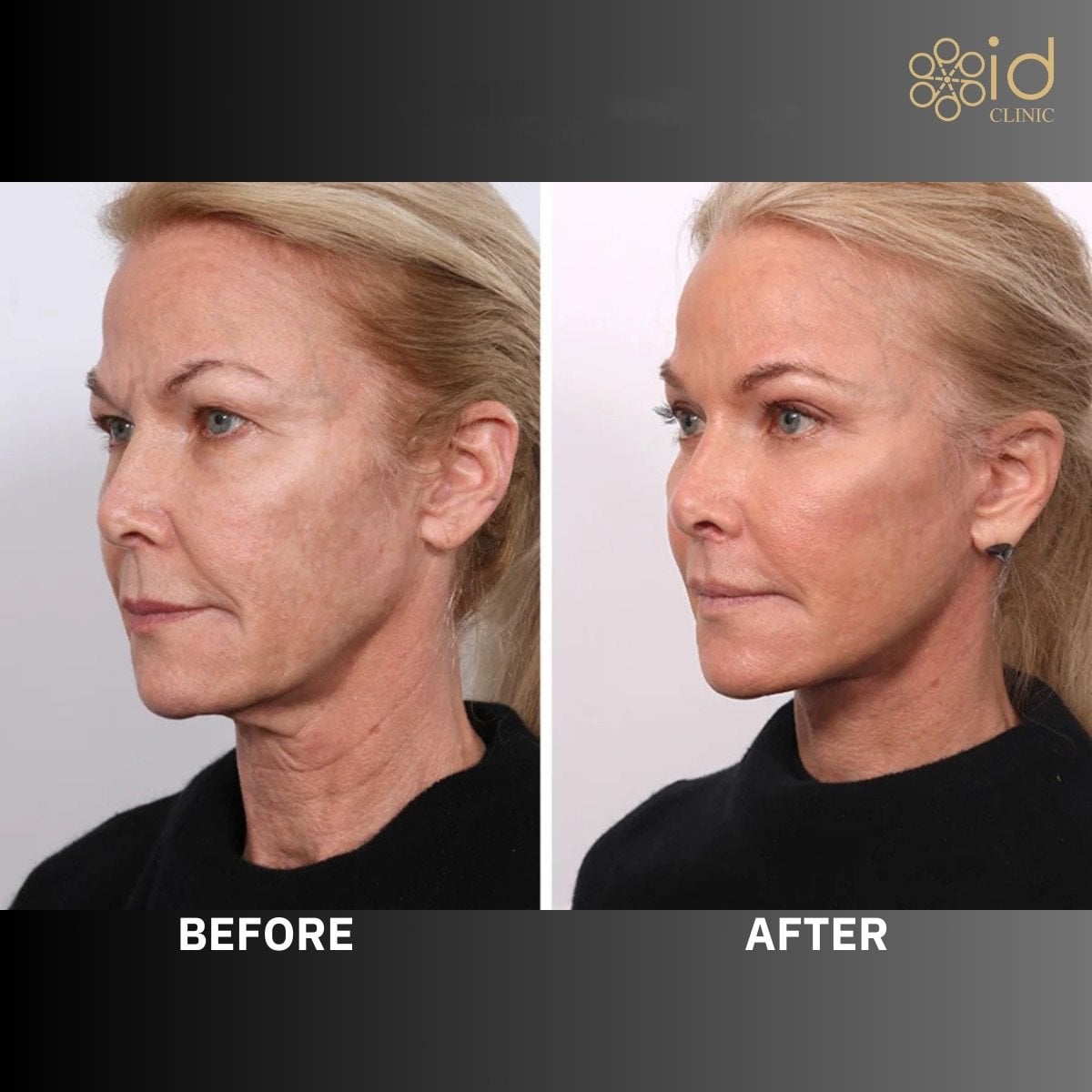 Resultados de blefaroplastia de párpado inferior antes y después en ID Clinic Bangkok