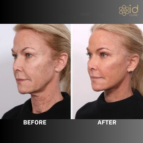 before-after photo lower-eyelid-surgery