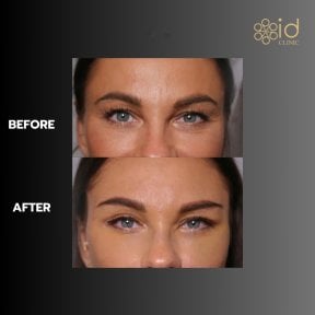 before-after photo lower-eyelid-surgery