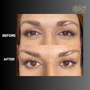 before-after photo lower-eyelid-surgery