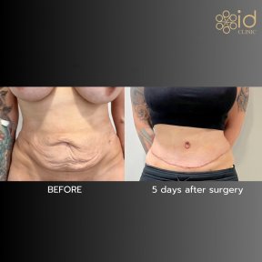 before-after photo liposuction