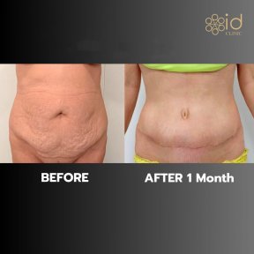 before-after photo liposuction