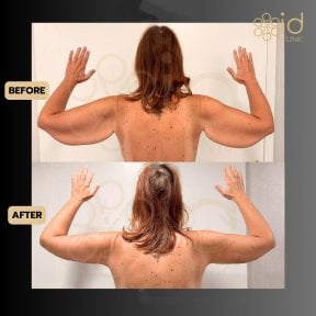 before-after photo arms-plastics-brachioplasty
