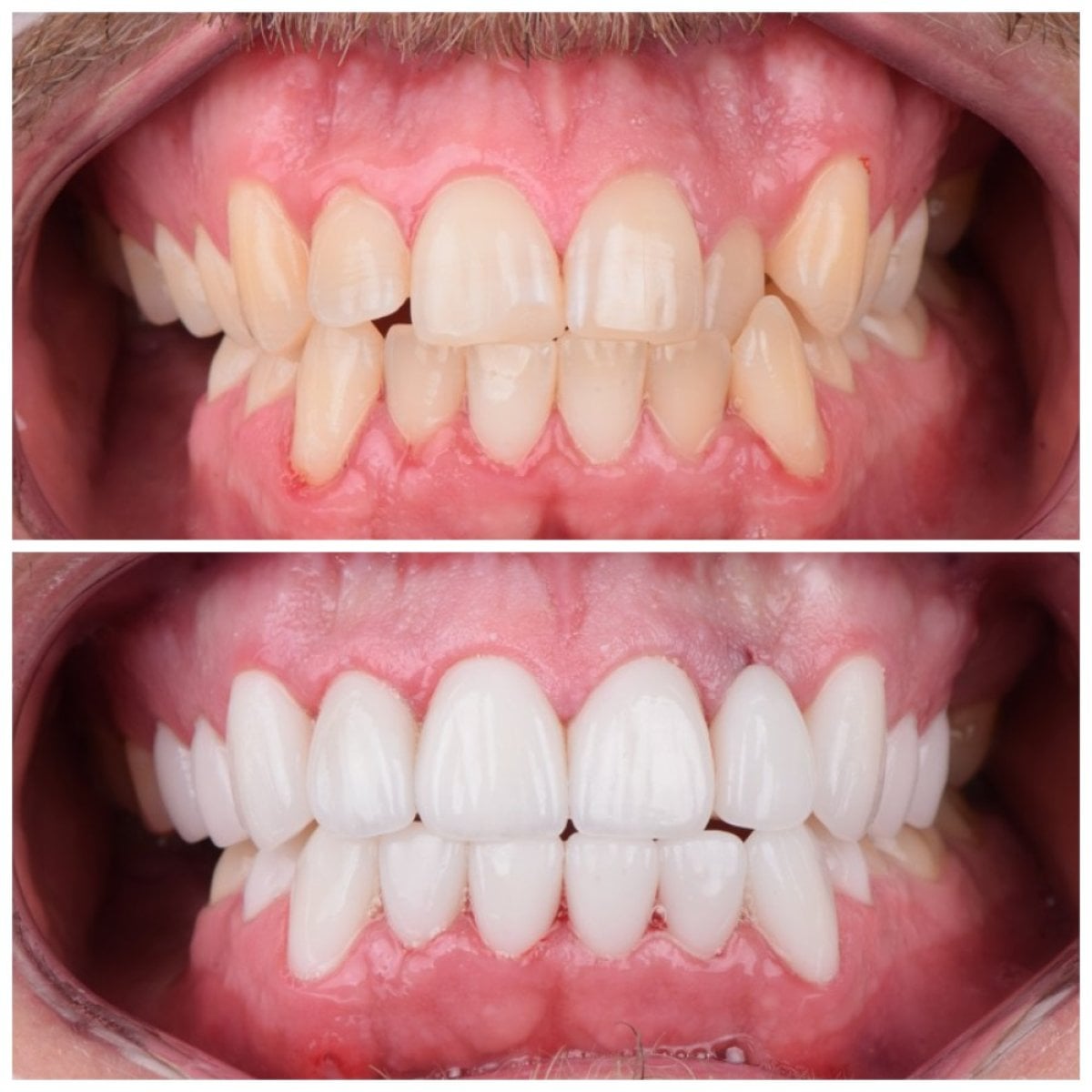 Resultado antes y después de carillas dentales: sonrisa mejorada y dientes alineados