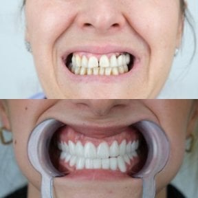 before-after photo dental-implant