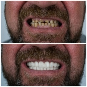 before-after photo dental-implant
