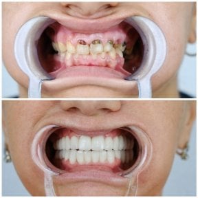 before-after photo dental-implant