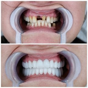 before-after photo dental-implant