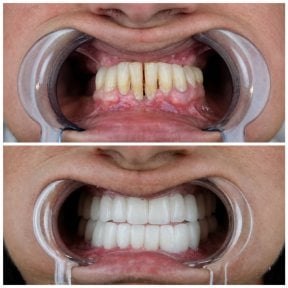 before-after photo dental-implant
