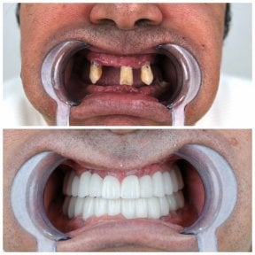 before-after photo dental-implant